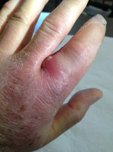 top of finger - getting bigger