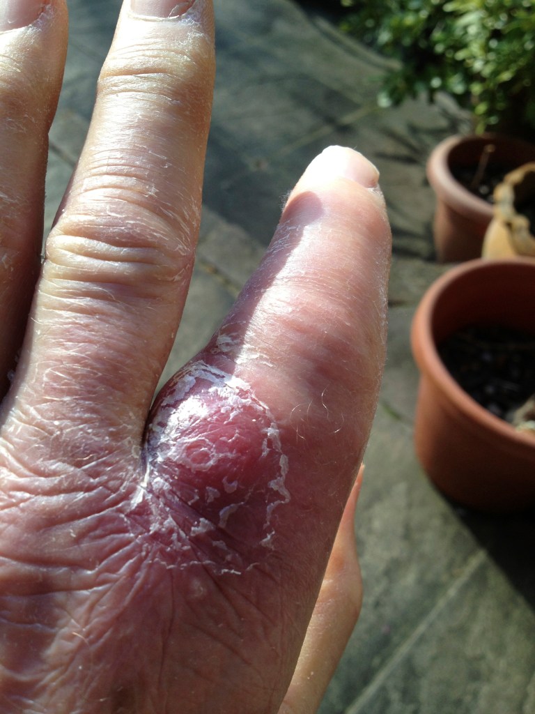 top of finger - bigger still