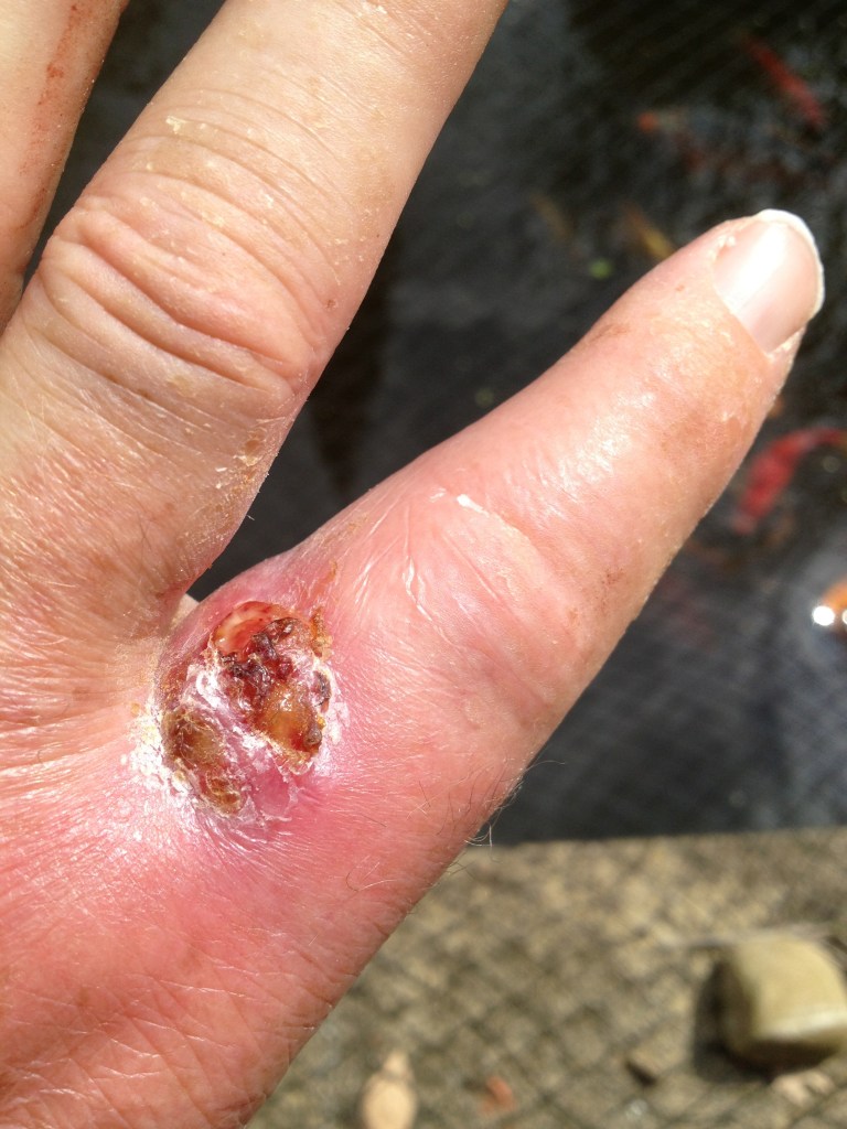 Left hand index finger - showing sinus on upper part of finger